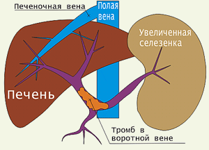 Заболевания печени: признаки, симптомы, анализы11