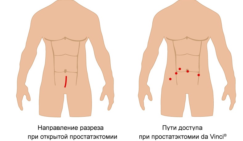 Ультразвуковая диагностика простаты11