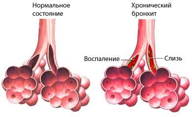 Силикатоз, асбестоз: симптомы, диагностика, лечение11