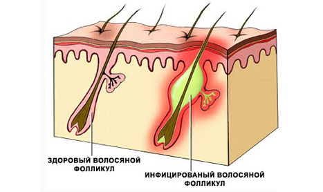 Инфекционные дерматозы: классификация и лечение11
