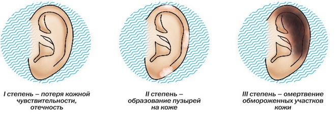 Ожог, обморожение, рожа у детей: первая помощь, лечение11