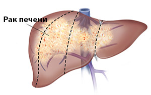 Цирроз печени: симптомы, лечение, стадии11
