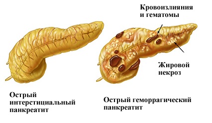 Панкреатит: симптомы, лечение, народные средства, фото, отзывы11