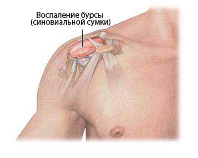 Боль в плечевом суставе: симптомы, лечение, причины, дискомфорт при поднятии руки12