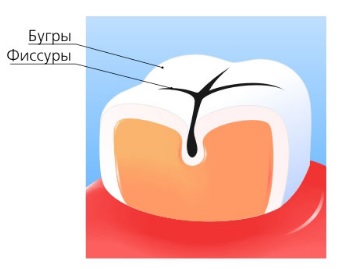 Препарирование зуба: показания, этапы, методы, последствия12