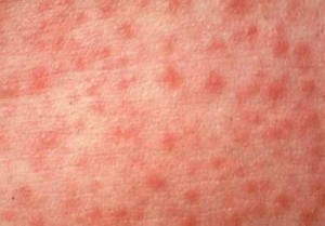 Сифилис: симптомы, лечение, фото, через что передается?12