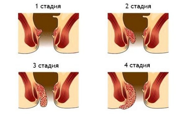 Дизентерия: симптомы и лечение у детей и взрослых12