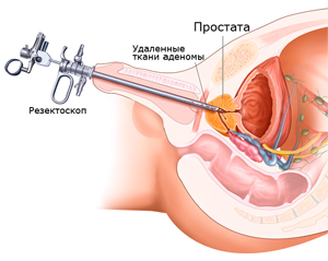 Дивертикулез мочевого пузыря: симптомы, диагностика, лечение12