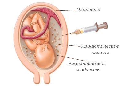 Перенашивание беременности. Последствия для ребенка13