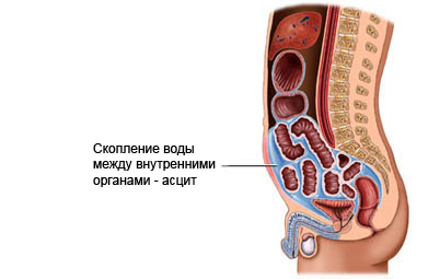 Рак печени: симптомы, лечение, сколько живут? 13