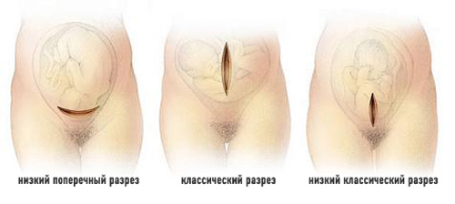 Сахарный диабет и беременность: риски, ведение, акушерская помощь13