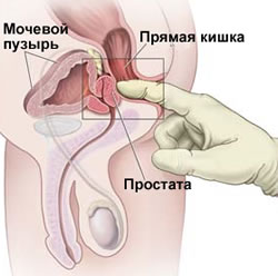 Рак простаты и наследственность13