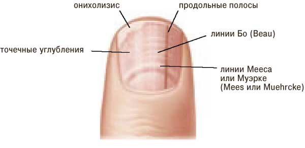Эпидермофития кисти, стопы: симптомы, диагностика, лечение, фото13