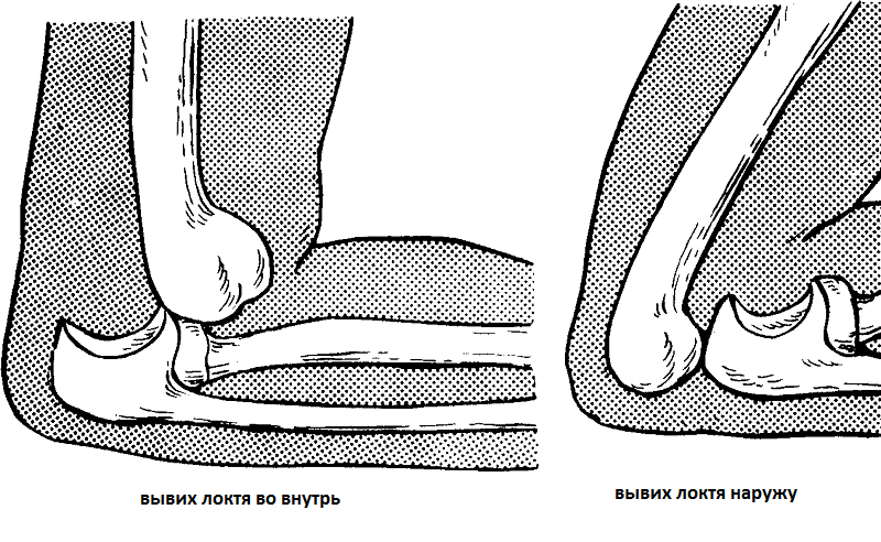 Боль в локте: причины и лечение, боли от плеча до локтя14