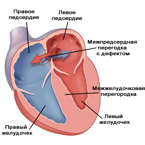 Диагностика тетрады Фалло. Дифференциальная диагностика патологии14