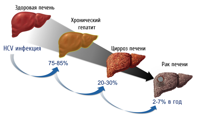 Рак печени: симптомы, лечение, сколько живут? 14