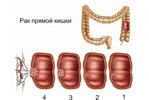 Проктит прямой кишки: симптомы, лечение, фото, отзывы14