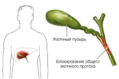 Печеночная недостаточность: острая, хроническая, симптомы, лечение14