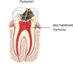 Резорбция корня: причины, симптомы, профилактика, лечение, последствия14