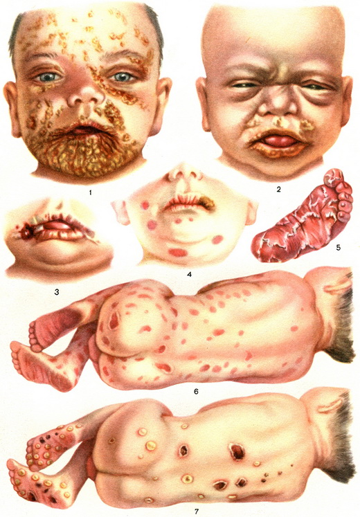 Сифилис: симптомы, лечение, фото, через что передается?15