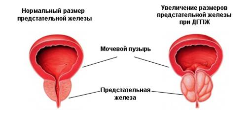 Рак простаты и наследственность15