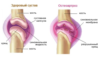 Болезни периферической нервной системы и опорно-двигательного аппарата, профессиональная дискинезия15