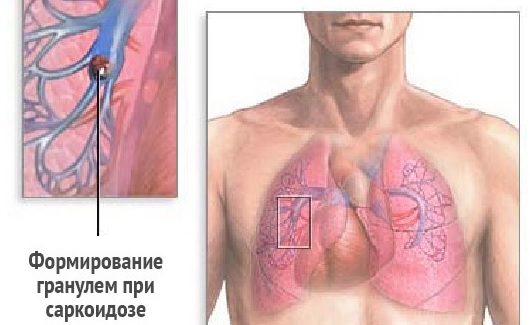 Пневмокониозы: диагностика, лечение15