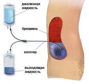 Токсическая нефропатия: симптомы, диагностика, лечение, фото15