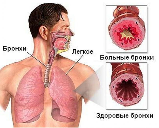 Силикатоз, асбестоз: симптомы, диагностика, лечение15