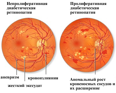 Сахарный диабет 1 типа у детей: этиология, лечение, профилактика15