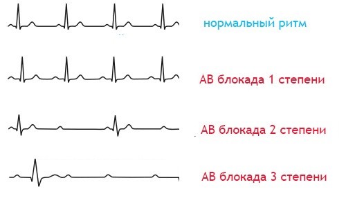 Тетрада Фалло: прогноз после операции, рекомендации врачей15