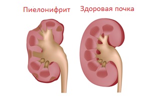 Инфекции при беременности. Оценка эффективности лечения16