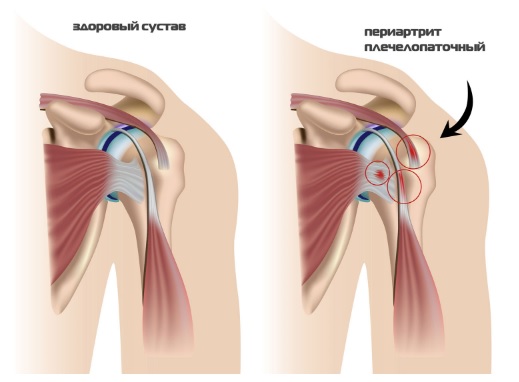 Болезни периферической нервной системы и опорно-двигательного аппарата, профессиональная дискинезия16