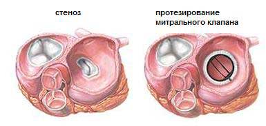 Злокачественная опухоль сердца16
