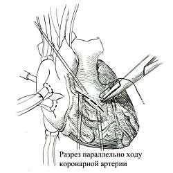 Лечение тетрады Фалло: способы, этапы, рекомендации врачей16