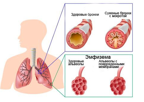 Пылевой бронхит: симптомы и лечение17