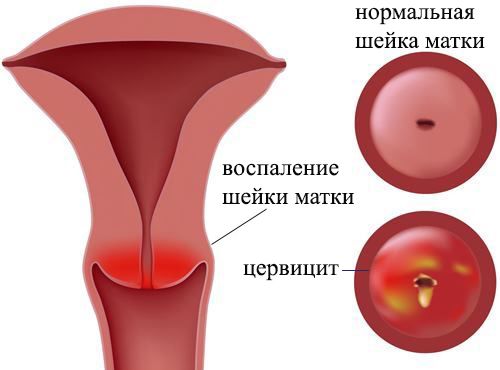 Осложнения гонореи у женщин и у мужчин17