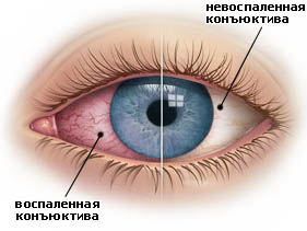 Пневмокониозы: диагностика, лечение18