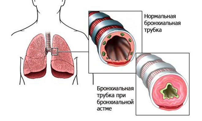 Пылевой бронхит: симптомы и лечение19