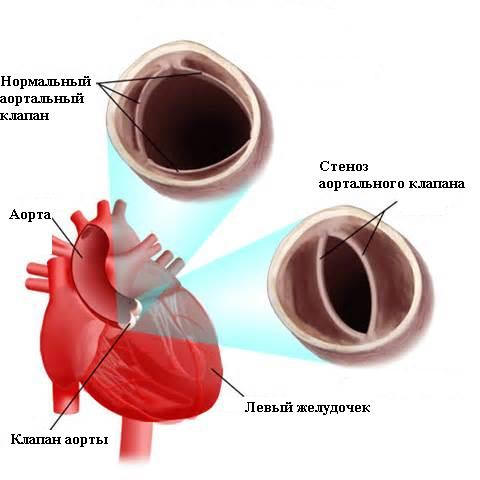 Корригированная транспозиция магистральных артерий 19