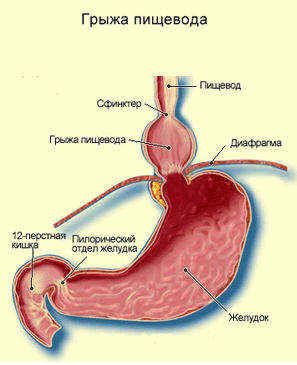 Грыжи пищевода: симптомы, лечение, диагностика, операция, фото1