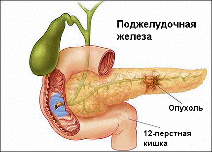 Болит поджелудочная, что делать?1