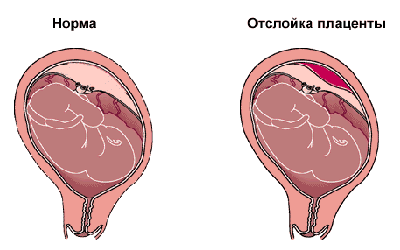 Отслойка плаценты: симптомы, лечение на разных сроках1