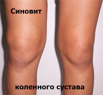 Существует не так много болезней, с которыми человек обязательно встречается в своей жизни. Список таковых недугов возглавляют болезни суставов и костей.  Вследствие постоянных физических нагрузок, инфекций и травм опорно-двигательные структуры способны повреждаться. Но даже при отсутствии вышеперечисленных факторов развиваются остеохондрозы и остеоартрозы, из-за того что хрящи с возрастом человека стареют, ухудшается их питание и кровоснабжение.  1 Первым признаком поражения сустава становится синовит (воспаление синовиальной оболочки). Она размещается на внутренней поверхности сустава и вырабатывает внутрисуставную жидкость, предотвращающую трение хрящей. Данная структура является самой «нежной» в суставе, поэтому симптомы синовита часто опережают признаки основного заболевания.  Статистические данные из национальной ассоциации травматологов указывают на то, что заболевания коленного состава находятся на первом месте по частоте встречаемости среди патологий опорно-двигательных структур. Поэтому развитие синовита чаще всего локализовано в этом месте.   Причины появления синовита коленного сустава и классификация 2 Развитие синовита могут вызывать воздействия многих факторов, которые условно разделяют на 3 группы:  •	инфекционные – повреждение сустава проникшими бактериями; •	неинфекционные – воспалительный процесс, поражающий синовиальную оболочку, происходит без участия микроорганизмов; •	травматические.  Поскольку причина заболевания влияет на выбор его лечения, в клинической практике применяют более подробную классификацию:  Форма синовита	Причина развития Острый травматический синовит	Повреждения сустава, травмирующие синовиальную оболочку. Травмы бывают 2 типов: •	прямые – воздействие было направлено непосредственно на сустав (удар по колену, падение на колено и т.п.); •	непрямые – повреждение сустава, вызванное воздействием на другие участки тела (резкий поворот бедра при фиксированной стопе) Острый инфекционный синовит	Попадание бактерий на синовиальную оболочку. Оно может наблюдаться: •	после пункций сустава; •	при открытых травмах (открытые переломы, проникающие ранения). Распространение инфекции по лимфатическому и кровеносному путям – достаточно редкое явление.  Хронический синовит	Наблюдается при нарушениях обмена веществ или хронических болезнях суставов.  Данная форма свойственна таким заболеваниям: •	Артриты (туберкулезный, псориатический, ревматоидный и т.д.) – заболевания суставов, вызванные инфекцией.  •	Остеоартроз – поражение сустава неинфекционной этиологии, при котором он постепенно разрушается.  •	Подагра – отложение солей мочевой кислоты в суставе вследствие нарушения ее обмена, что приводит к воспалению синовиальной оболочки. Мигрирующий синовит	Развивается на фоне ревматической лихорадки. Ворсинчато-узелковый (виллонодулярный, пигментный) синовит 	Редкостная форма опухоли, когда происходит рост клеток синовиальной оболочки. Причина развития этой формы заболевания пока не установлена.  Если точно назвать причину болезни не получается, врачи в истории болезни указывают диагноз «неуточненный синовит».   Симптомы  На развитие симптоматики синовита коленного сустава не влияет причина заболевания (за исключением острого инфекционного синовита). Они определяются выраженностью болезненного процесса и продолжительностью течения. Поэтому признаки недуга рассматривают отдельно для острой и хронической формы.  3 Признаки острого синовита  Эта форма характеризуется быстрым появлением и нарастанием симптомов. В первую очередь появляется боль, имеющая следующие особенности: •	не ограничивается отдельной точкой, а распространяется на весь сустав; •	обычно отличается достаточно интенсивным болевым синдромом; •	наблюдается усиление болевых ощущений утром и ослабление боли под вечер; •	незначительно утихает в состоянии покоя.   Через небольшой период времени после возникновения болевого синдрома в области сустава может образовываться припухлость по причине повышенной выработки внутрисуставной жидкости. Полностью согнуть и разогнуть сустав нельзя, поскольку такое действие усиливает боль. Поэтому активные движения сустава неско4лько  ограничиваются (на 10-15 градусов).   Если человек страдает острым инфекционным синовитом, местные симптомы могут сопровождаться признаками интоксикации: снижение аппетита, головная боль, слабость, повышение температуры (до 38 градусов). Если заболевание не лечить, бактериальный синовит может спровоцировать флегмону коленного сустава 4  Признаки хронического синовита  По сравнению с острой формой в течении хронического синовита можно выделить периоды ремиссий и обострений.   По своей силе болевой синдром в первые несколько лет заболевания идентичен боли при острой форме. Однако позже суставные хрящи постепенно разрушаются, истончаются стенки капсулы сустава. Вследствие этого:  •	усиливаются боли; •	значительно ограничиваются движения коленного сустава; •	сустав характеризуется «нестабильностью» – у таких больных встречаемость вывихов намного выше, чем у здоровых людей.   Лихорадочный симптом для хронической формы несвойственный. В период обострений температура может повышаться до 37 градусов. При правильном лечении у пациента остаются только признаки умеренного синовита, которые почти не влияют на качество его жизни.   Диагностика  Заподозрить наличие синовита можно на основе анализа жалоб пациента. Чтобы определить форму заболевания, нужно обратить внимание на возможные ее причины. Для подтверждения диагноза проводится дополнительное обследование:  •	Анализы крови:  o	В биохимическом анализе необходимо посмотреть уровень С-реактивного белка. Если он превышает 10 нг/мл – это говорит об иммунном воспалении (ревматическом или псориатическом синовите); o	В общем анализе крови на присутствие воспалительного процесса указывает повышение СОЭ и увеличение числа лейкоцитов (более 9,0*109).  o	В серологическом анализе могут быть выявлены антитела к стрептококку (антистрептогиалуронидаза, АСЛО, антистрептокиназа) – это признак мигрирующего или ревматоидного синовита.  •	Рентгенография пораженного сустава (в боковой и прямой проекциях). •	Флюорография – используется для выявления туберкулезного синовита (однако заболевание часто протекает как внелегочная патология при «чистых» легких).  •	Артроскопия – проводится при тяжелых случаях диагностирования. В ходе данной процедуры врач надрезает кожу в области сустава и вводит в его полость камеру с фонариком. Обнаружив патологический очаг заболевания, врач осуществляет лечение «на месте».   5 После подтверждения наличия синовита и определения его формы можно перейти к подбору тактики лечения.   Лечение  Как следует лечить синовит коленного сустава? Терапия базируется на выяснении двух основных моментов: причины появления болезни и механизма ее развития. Если врач сможет избавиться от воздействия этих факторов, синовит для пациента останется в прошлом. К сожалению, при наличии  целого ряда заболеваний вылечить синовит полностью не удастся. К таковым относятся: •	подагра; •	псориатический и ревматоидный артриты; •	остеоартроз и некоторые другие.  Для каждой отдельной формы синовита разработаны свои схемы лечения, позволяющие вернуть нормальное функционирование сустава или поддерживать качество жизни больного на приемлемом уровне.  7       Острый травматический синовит: лечение   В схеме лечения этой формы синовита можно выделить следующие пункты: •	Лечение травмы – при открытом переломе хирург занимается восстановлением нормального состояния костей, расположенных внутри сустава, если имеются повреждения – сшивает поврежденные участки капсулы и поврежденные связки, а также ушивает кожный покров над раной.  •	При открытых и закрытых  внутрисуставных переломах пациенту проводят «скелетное вытяжение» – через кости, образующие сустав, протягивают спицы и подвешивают тяжесть, чтобы избежать их повторного смещения. Обычно в таком состоянии больной должен находиться до 3 недель, если ранее не назначена операция.  •	При проявлении признаков синовита пациенту назначают: o	Негормональные противовоспалительные препараты в форме таблеток или внутримышечно. Чаще всего прописывают Нимесулид (Найз), Ибупрофен, Кеторолак (Кетопрофен, Кеторол), Диклофенак.  o	Чтобы устранить побочные эффекты в виде язв желудка и двенадцатиперстной кишки, назначают прием «ингибиторов протонной помпы» – Рабепразол, Омерпазол и т.д.  o	На период «скелетного вытяжения» пациента отправляют проходить физиотерапевтические процедуры (фото- или магнитотерапия), которые способствуют заживлению тканей. Также они производят противовоспалительный эффект, что снижает выраженность синовита. o	При сильной припухлости области колена, вызванной большим скоплением внутрисуставной жидкости, проводится операция по удалению ее излишков.  После снятия спиц на поврежденную ногу накладывают гипс, который пациент должен носить в течение 6-8 недель. На этом этапе синовит проявляется достаточно редко, и обнаружить его можно только при снятии гипсовой повязки. Лечат заболевание по вышеописанной схеме.  6  Рекомендовано ли применение НПВС-мазей? Сегодня бытует мнение, что по фармакологическому действию мази лучше внутримышечных уколов и таблеток, поскольку их целенаправленно наносят на поврежденный участок. Однако современные клинические исследования опровергли эту теорию. Все НПВС являются ингибиторами фермента, который способствует развитию воспалительного процесса. Они обладают одинаковой эффективностью вне зависимости от места их введения. Сравнительно с другими формами лекарственных препаратов мази плохо всасываются, поэтому их не рекомендуют использовать в нынешнее время.  При адекватном лечении симптомы синовита исчезают через 5-11 дней.  Острый инфекционный синовит: лечение  Эта форма заболевания характеризуется тем, что, кроме избытков жидкости, внутри сустава скапливается гной и находятся бактерии, постепенно разрушающие капсулу, связки и хрящи. Поэтому важно вовремя проводить пункцию коленного сустава с введением обеззараживающих растворов. 8 Как выполняют пункцию коленного сустава? Эта операция не требует от пациента никакой подготовки. Сначала область прокола обрабатывается раствором спирта (70%), а потом раствором йода. Далее кожу местно обезболивают новокаином или лидокаином и делают прокол. Прежде всего откачивают внутреннее содержимое сустава, потом промывают его антисептиком и производят повторное откачивание до того момента, пока гнойное содержимое не будет полностью удалено. Меры антибактериальной терапии аналогичны таковым при острой форме травматического синовита. Назначают макролиды или антибиотики пенициллинового ряда. Они обладают лучшей эффективностью и минимальным количеством побочных эффектов.  Показаны следующие лекарственные препараты: •	Макролиды: o	Азитромицин. o	Эритромицин. o	Джозамицин (рекомендовано принимать беременным женщинам и детям). •	Пенициллины:  o	Ампициллин. o	Амоксициллин. o	Амоксиклав (если пациент недавно закончил прием антибиотиков или вышеописанные препараты не оказали положительного эффекта).  Физиотерапевтические процедуры противопоказаны при инфекционных процессах, ведь они способствуют увеличению количества бактерий. Поэтому данный метод лечения не применяют при инфекционном синовите.   Лечение ревматоидного, псориатического синовита  Представленные формы синовита возникают на фоне ревматоидного артрита. Для их устранения следует заняться лечением основного заболевания. С этой целью назначается комплексная терапия, состоящая из следующих элементов:  •	Противовоспалительное лечение – при положительном эффекте от НПВС можно принимать на регулярной основе только эти препараты вместе с Омепразолом. Если прием нестероидных противовоспалительных препаратов окажется неэффективным, пациенту назначаются гормоны (Гидрокортизон, Преднизолон), дозировку приема которых врач определяет индивидуально.  •	Хондропротекторные средства – используются для сохранения тканей коленного сустава. Эффективным и недорогим препаратом этой группы является Хондроитин. •	Снижение нагрузки на сустав – уменьшает болевой синдром. Для разгрузки коленного сустава больному рекомендуют ходить с тростью.  •	Физиотерапия – обезболивающие процедуры, направленные на пораженный участок. Разрешено применение любых методик: УВЧ-терапия, фото- и магнитотерапия, гальванизация.  Лечение должно происходить под строгим контролем врача-ревматолога. Самостоятельная терапия этой формы синовита недопустима.   Туберкулезный синовит: лечение  Туберкулезный синовит представляет собой особую форму, которая развивается на фоне туберкулеза легких. Его лечение выполняется в комплексе с терапией основного заболевания в специализированных диспансерах. При подозрении на развитие туберкулезного синовита следует обратиться к терапевту или врачу-фтизиатру.  Обычно это заболевание хорошо поддается лечению. После 9 месяцев адекватной терапии признаки туберкулезного синовита полностью исчезают.  9  Лечение инфекционного синовита, развивающегося на фоне остеоартроза Синовит, протекающий на фоне остеоартроза, требует особого подхода к выбору терапии.  В качестве основного лечения применяют НПВСы. Однако для предотвращения повторного развития синовита нужно улучшить кровообращение пораженного сустава. Этой цели проще всего достичь при помощи физиотерапии, которую назначают уже с первых дней болезни.  10  Терапия мигрирующего синовита  Чтобы излечить эту форму, необходимо проводить не только комплексную терапию синовита, но и ревматической лихорадки. Рекомендуют применение следующей схемы лечения: •	Назначение соблюдения постельного режима на 2-4 недели. •	НПВС (Ибупрофен или Кеторолак) – для снижения выраженности воспаления и устранения болевого синдрома.  •	Бензилпенициллин – антибиотик, который предназначен для устранения стрептококка, послужившего причиной заболевания.  •	Внутривенное вливание препаратов с физиологическим раствором (капельницы с хлоридом натрия) – предназначено для устранения интоксикации.    Врач может расширить терапию, если в этом будет необходимость. Лечение мигрирующего синовита требует госпитализации больного на срок около одного календарного месяца.   Лечение ворсинчасто-узелкового синовита  Данная форма синовита по своей природе представлена доброкачественной опухолью. Самым эффективным вариантом ее лечения станет удаление образования. Для этого в настоящее время проводят артроскопические операции:  •	делают два маленьких разреза по 1-2 см; •	внутрь сустава вводят инструменты, один из них представлен камерой с фонариком, а второй – пинцетом или электрическим ножом; •	с их помощью проводят удаление опухоли; •	завершив процедуру удаления, зашивают разрезы.       Терапия подагрического синовита  Синовит при подагре – частое явление, которое развивается из-за отложения в полость сустава солей мочевой кислоты, что вызывает воспаления синовиальной оболочки и раздражения капсулы. Наиболее эффективным способом лечения будет соблюдение диеты, при которой необходимо: •	исключить рыбные и мясные продукты; •	ограничить кофе, чай; •	исключить алкоголь; •	исключить свеклу, грибы, бобовые и зелень (салат, щавель, петрушку, лук и т.д.); •	употреблять минеральные воды (Ессентуки, Нарзан).   видео  Медикаментозное лечение включает:  •	НПВС в периоды обострений, если они неэффективны – прием гормонов (Гидрокортизон или Преднизолон). •	Колхицин – препарат, предназначенный для устранения приступов. •	Постоянный прием лекарств, выводящих мочевую кислоту из организма, – Аллопуринол или Бензброманон.   Если не придерживаться специальной диеты в терапии подагрического синовита, прием лекарств окажется бесполезным.   Народное лечение синовита  Кроме традиционного медикаментозного лечения, в терапии синовита коленного сустава возможно использование народных средств. Их эффективность не подтверждена клиническими исследованиями, но среди населения такая практика является весьма распространенной. Эти методики в основном направлены на местное применение травяных сборов, мазей и настоек для снижения воспаления. К ним относятся такие рецепты:  Название рецепта	Аптечные аналоги (зарегистрированные в реестре лекарств) 	Методика домашнего приготовления и способ применения  Лавровое масло	Отсутствует в РЛС	•	Измельчить 2 столовые ложки (40 грамм) лаврового листа. •	Смешать с 200-250 граммами оливкового или подсолнечного масла. •	Перемешать, перелить в тару и настаивать на протяжении 7 дней. •	Раствор, полученный после отстаивания, процедить и перелить в чистую емкость.  Полученный бальзам используют местно, прикладывая примочки на пораженный сустав на протяжении нескольких часов.   Противовоспалительный травяной сбор	•	«Ротокан» – для применения внутрь.  •	«Эвкаром» – для местного применения.  	•	Смешать в одинаковом количестве: корень аира, чистотел, алтей, эвкалипт, душицу, валериану, пижму, чабрец, зверобой, календулу, омелу. •	Просушить растения и сложить их в металлическую/стеклянную посуду. •	Перед применением залить кипятком 1 столовую ложку сбора и настаивать в течение 3-4 минут.   Полученный раствор принимать в течение дня, распределив его на 4 приема. Полный курс лечения – 2 месяца.  Окопниковая мазь	•	«Живокост». •	«Доктор Тайсс Окопник». 	•	Взять 70 грамм (стакан) травы окопника. •	Перемешать ее вместе с просоленным салом. •	Закрыть все в герметичной емкости и поставить в холодильник на 5 суток. Полученную мазь использовать в виде примочек, которые накладывать на пораженный сустав два раза в день.   Отвар из окопника	Отсутствует в РЛС	Запарить кипятком одну столовую ложку (15 грамм) измельченного корня окопника. Настаивать на протяжении часа. Распределить полученный настой на 4 порции и выпить их в течение дня.  Полный курс приема – один месяц.     Настойка на основе окопника	Отсутствует в РЛС	•	Измельчить полстакана (30-40 грамм) корня окопника. •	Залить 0,5 л водки. •	Перелить в герметичную тару и настаивать в темном месте в течение недели.  Полученную настойку пить три раза в день по 1 чайной ложке.    Нужно отметить, что использовать описанные выше рецепты традиционная медицина не рекомендует. Использование народных методов для лечения синовита коленного сустава допустимо только в комплексе с классической терапией. В других случаях они не дадут положительного результата.   Методы лечения, как и симптомы синовита коленного сустава, разнообразные, что усложняет первичную диагностику заболевания и выбор терапии. При возникновении подозрений на заболевание следует отправиться на прием к врачу-специалисту, который найдет причину болезни и поможет избавиться от ее симптомов. 1
