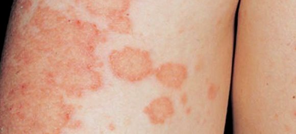Экзема начальная стадия: лечение, фото, на руках и ногах1