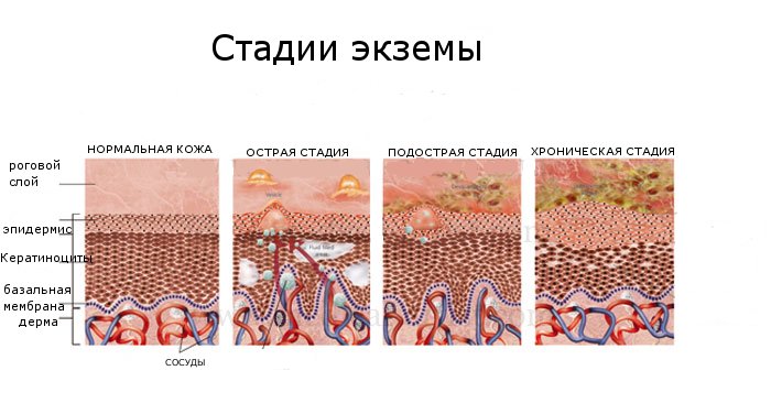 Программа борьбы с экземой1