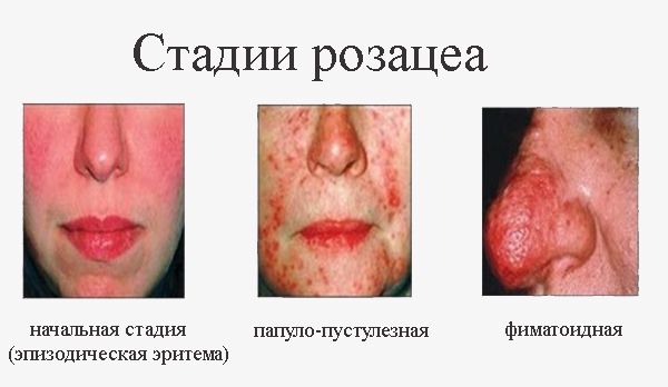 Розацеа: фото, лечение, причины, отзывы1