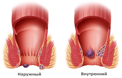Внутренний геморрой: симптомы, лечение, причины возникновения1