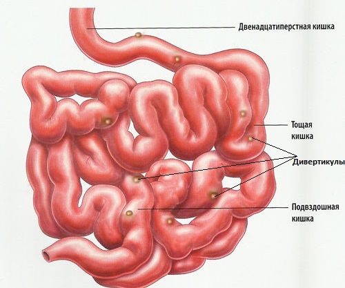 Дивертикулез кишечника