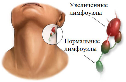 Болят лимфоузлы на шее, что делать?1